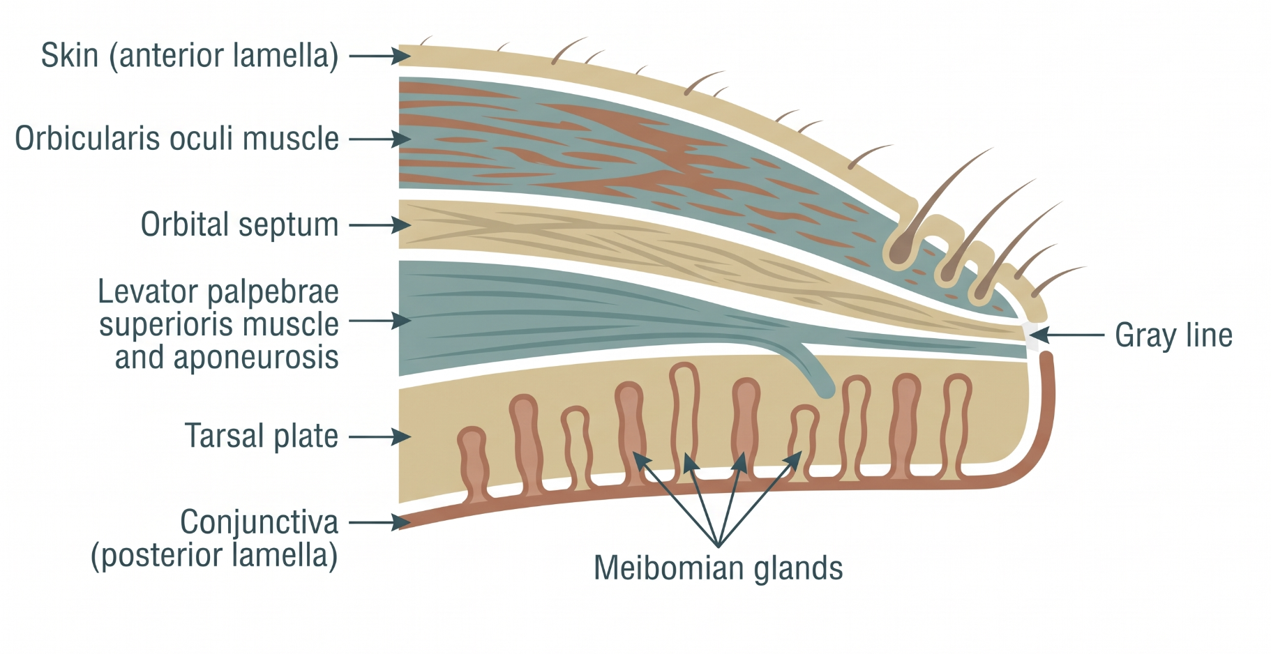 Cross-section of the eyelid showing the anterior lamella (skin, orbicularis oculi), the orbital septum, the posterior lamella (levator palpebrae superioris and aponeurosis, tarsal plate with meibomian glands, conjunctiva), and the gray line marking the boundary between them